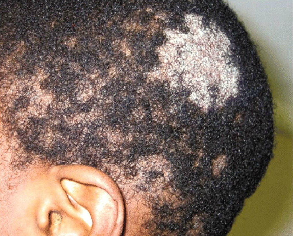 scalp disorders ringworm