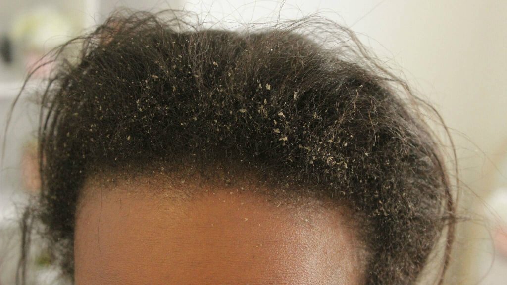 scalp disorders - dandruff